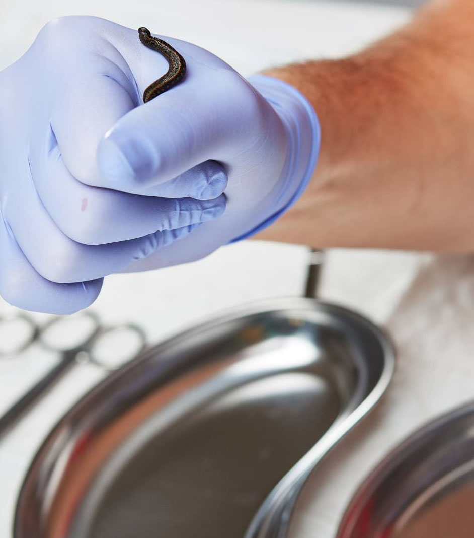 Hirudoterapeuta trzymający pijawkę lekarską podczas zabiegu